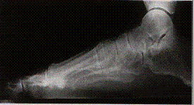 Posicionamiento Lateral Pie con Carga